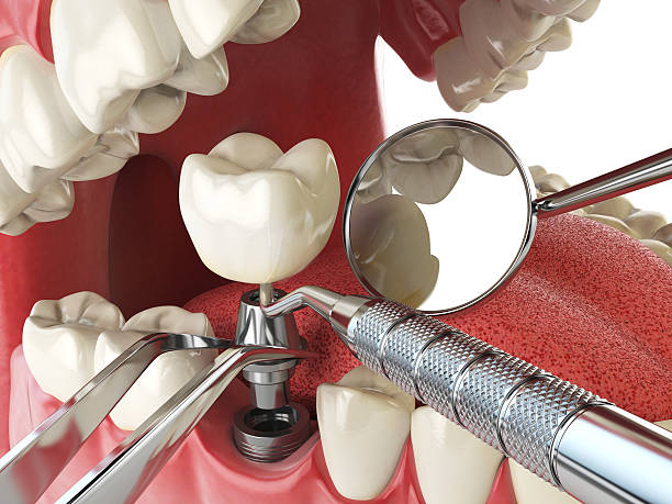 Best Broken or Chipped Tooth Repair in Ruston, LA